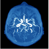 angiotomografia arterial de crânio agendar Jaçanã