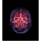 angiotomografia arterial de crânio Jabaquara