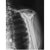 clínica de exame de ressonância do ombro Butantã