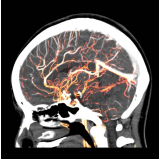 exame de angiotomografia arterial de crânio Vila Romana