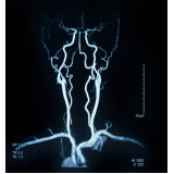 exame de angiotomografia cerebral Tucuruvi