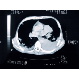 exame de angiotomografia pulmonar Saúde