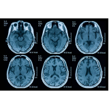 exame de tomografia cerebral Jardim Ângela