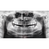 exame tomografia maxilar onde fazer Osasco