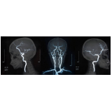 marcar exame de angiorressonância cerebral arterial Vila Pompeia