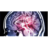 marcar exame de angiorressonância cerebral Centro