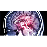 marcar exame de angiorressonância cerebral Santa Efigênia