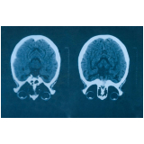 marcar exame de ressonância magnética do cérebro Água Branca