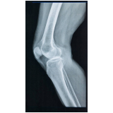 marcar exame de ressonância magnética do joelho Paineiras do Morumbi
