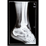 marcar exame de ressonância magnética do tornozelo Ibirapuera