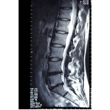 ressonância magnética da coluna lombar clínicas Imirim