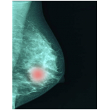 ressonância magnética de mama clínicas Vila Mazzei