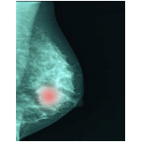 ressonância magnética de mama clínicas Francisco Morato