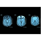 ressonância magnética do cérebro clínicas Centro