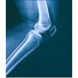 ressonância magnética no joelho clínicas Raposo Tavares