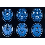 tomografia cerebral Glicério