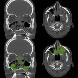 tomografia computadorizada dos seios da face marcar data Chora Menino