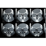 tomografia computadorizada dos seios da face Pirapora do Bom Jesus