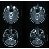 tomografia computadorizada do crânio