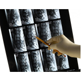 tomografia da coluna lombar Água Funda