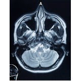 tomografias computadorizadas dos seios da face Butantã