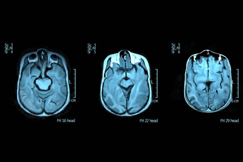 Tomografia Cerebral Agendar Itapevi - Tomografia de Crânio