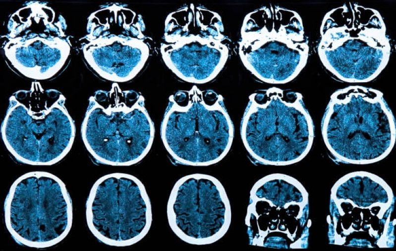 Tomografia Computadorizada do Crânio Jabaquara - Tomografia Computadorizada de Crânio