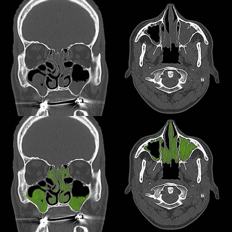 Tomografia Computadorizada dos Seios da Face Marcar Data Bairro do Limão - Tomografia Computadorizada de Crânio