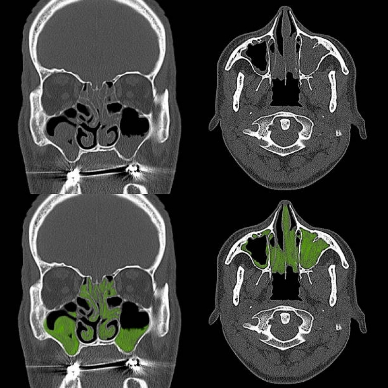 Tomografia Computadorizada dos Seios da Face Marcar Data Água Funda - Tomografia Computadorizada da Face