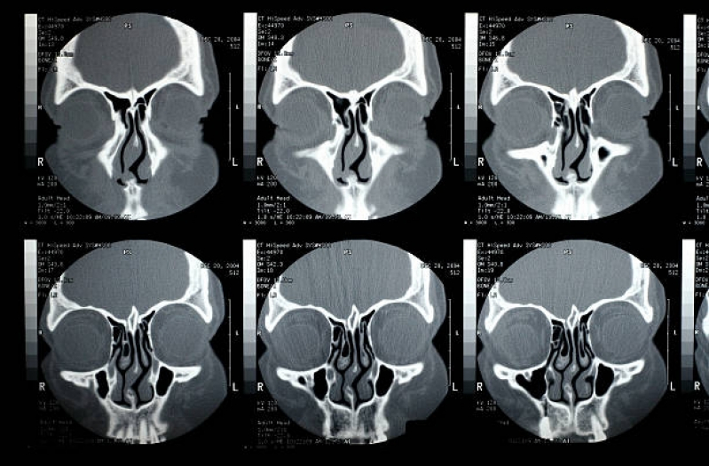 Tomografia Computadorizada dos Seios da Face Sé - Tomografia Computadorizada do Crânio