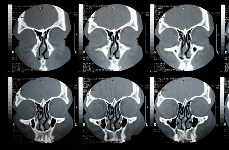 Tomografia Computadorizada dos Seios da Face Itapevi - Tomografia Computadorizada dos Seios da Face