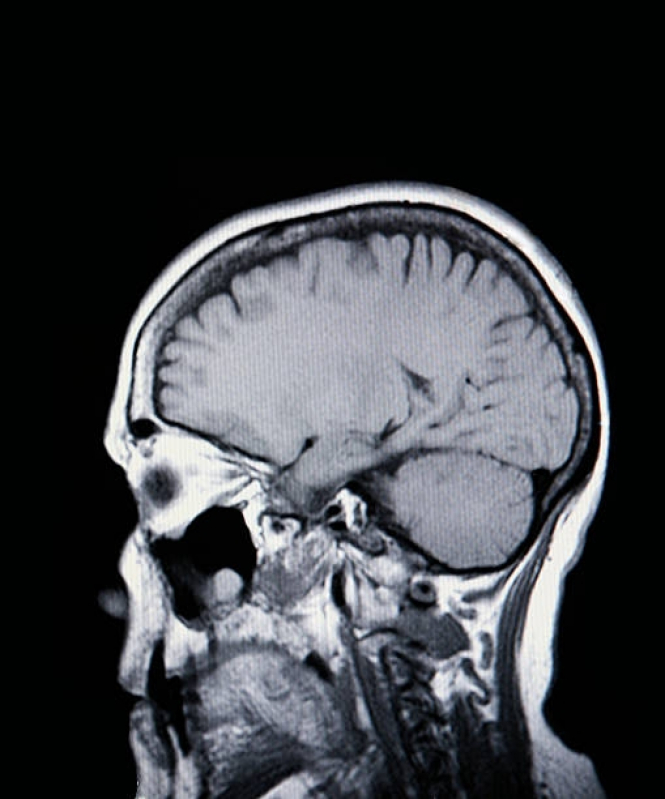Tomografia da Face Mogi das Cruzes - Tomografia Cerebral