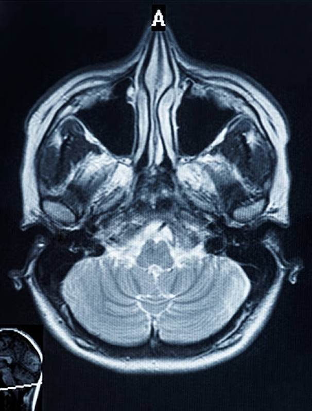 Tomografias Computadorizadas dos Seios da Face Jaçanã - Tomografia Computadorizada do Tórax