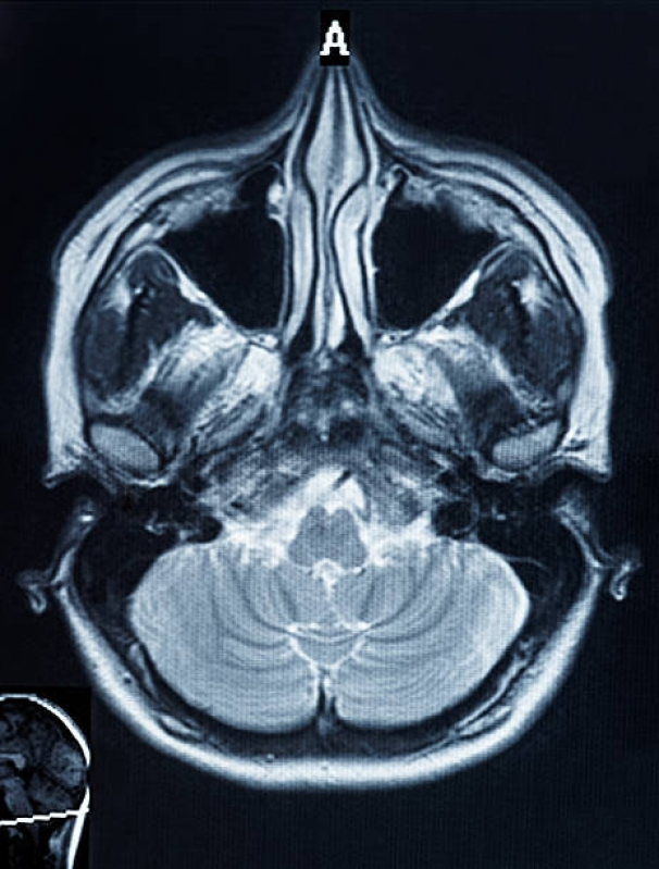 Tomografias Computadorizadas dos Seios da Face Itaquaquecetuba - Tomografia Computadorizada da Coluna